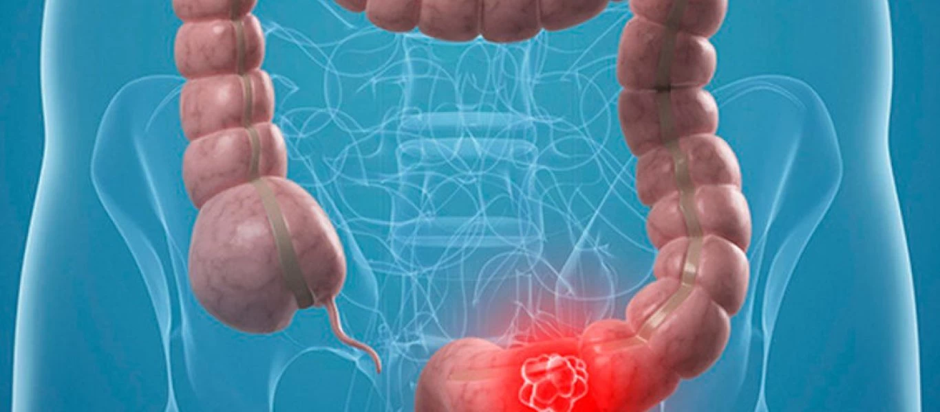 Αυτός είναι ο μεγαλύτερος ένοχος για τον καρκίνο του εντέρου